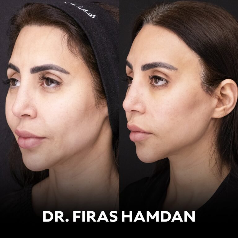 Deep plane facelift in dubai