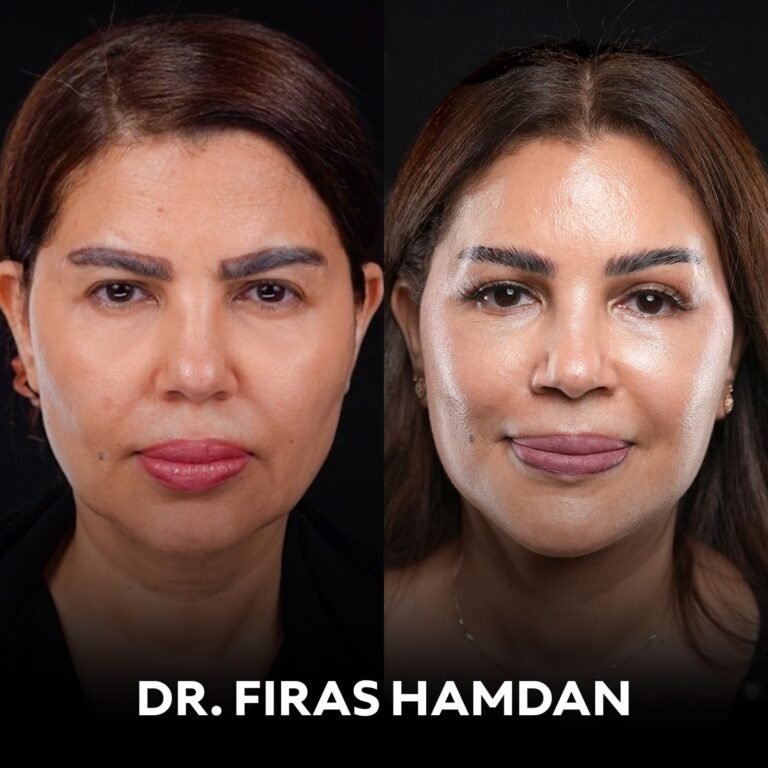Deep plane facelift dubai