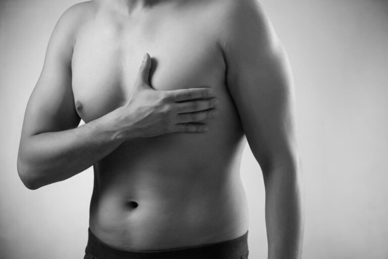 Gynaecomastia BY dr firas Hamdan