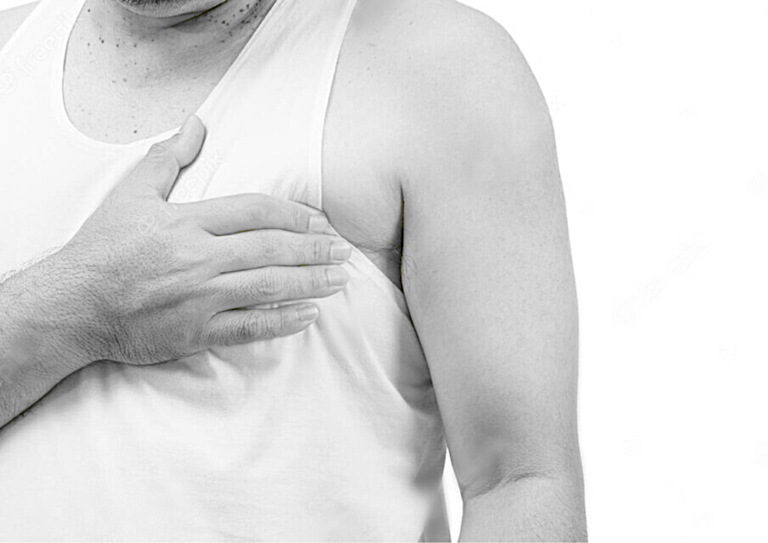 Gynaecomastia In Dubai