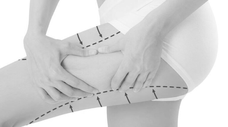 Thigh Lift Surgery
