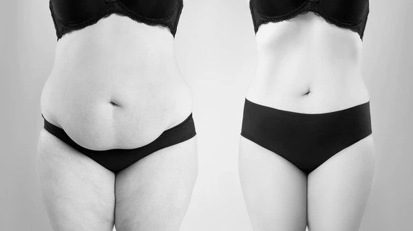 Mommy Makeover in Dubai by Dr firas