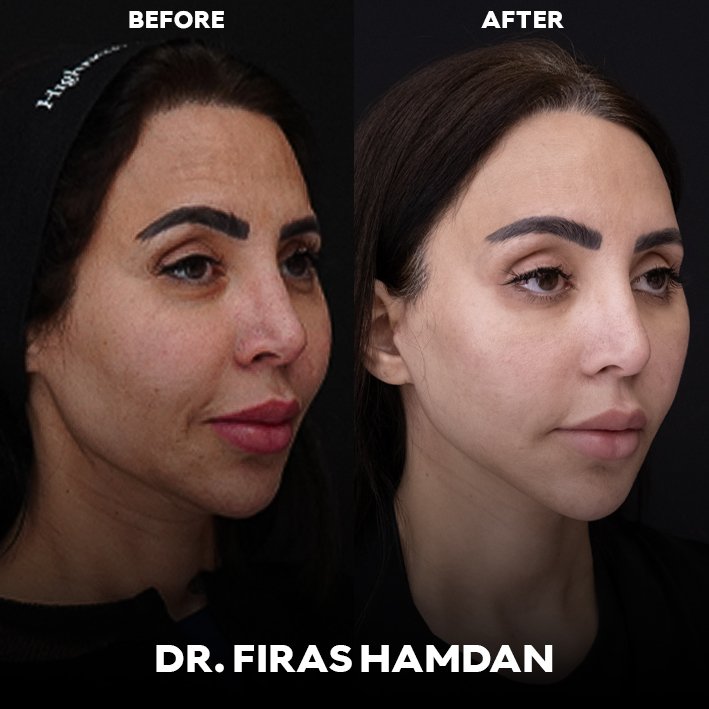 Endoscopic Forehead Lift In Dubai