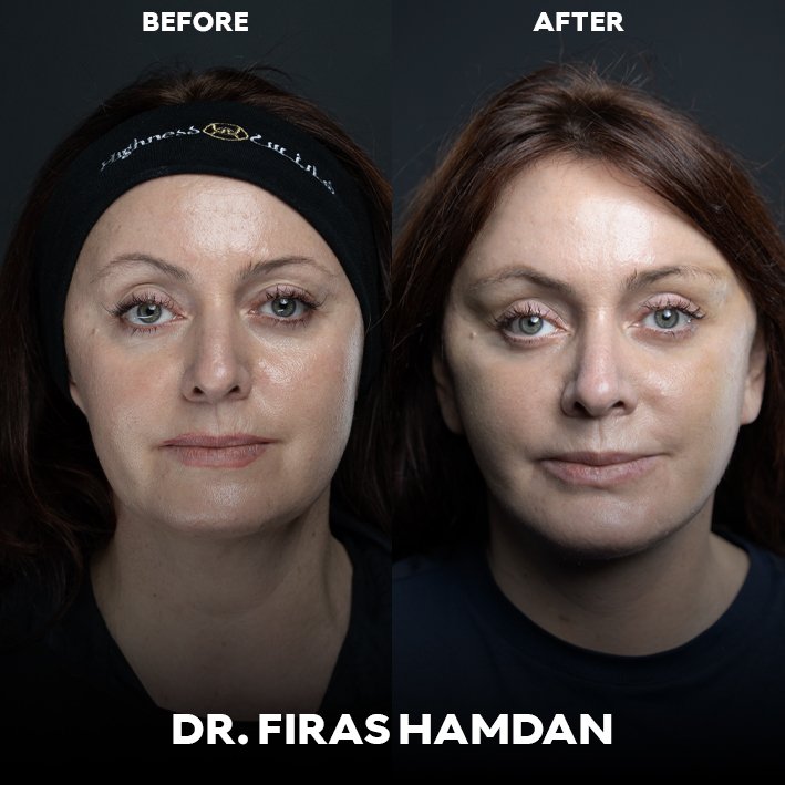 Endoscopic Forehead Lift Dubai